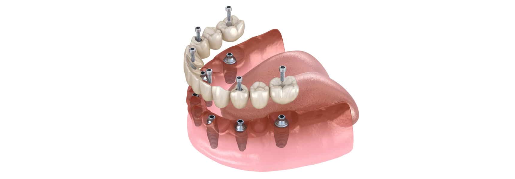 Implant Dentures Wyomissing Dentist Compass Dental